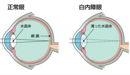 莎普爱思白内障如何检查