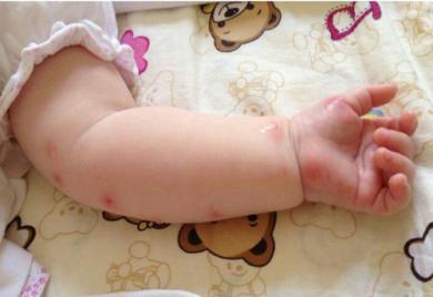婴儿被蚊子咬了怎么消肿止痒