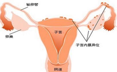 子宫内膜异位症食疗法