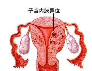 子宫内膜异位症病因