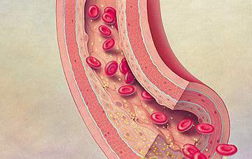 中老年动脉硬化