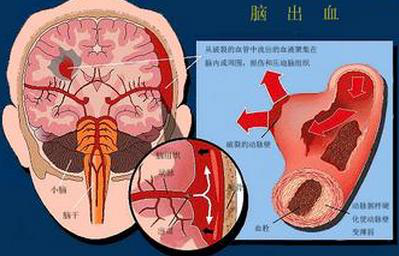 脑出血怎么食疗