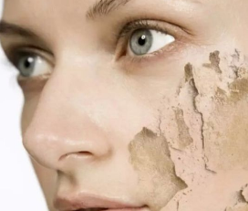 皮肤干燥起皮是什么病