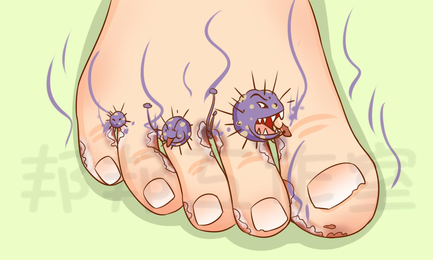 想过没有？你的脚丫居然是真菌生长的温床 春夏季脚趾间糜烂变成“烂脚丫”，原来是这个原因