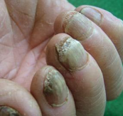 指甲变灰是什么病