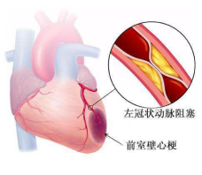 心梗合并心衰治疗方法是什么