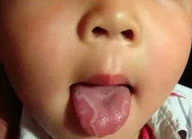 宝宝地图舌能自愈吗