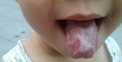 小孩地图舌吃什么中成药有效