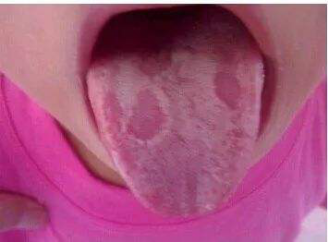 幼儿地图舌的危害有哪些
