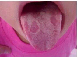 小孩地图舌有什么症状