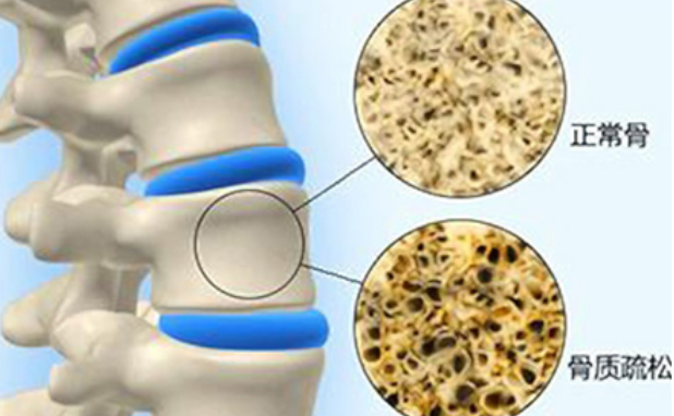 骨质疏松治疗手段