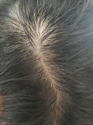 脂溢性脱发最佳治疗方案是什么？还有救吗？