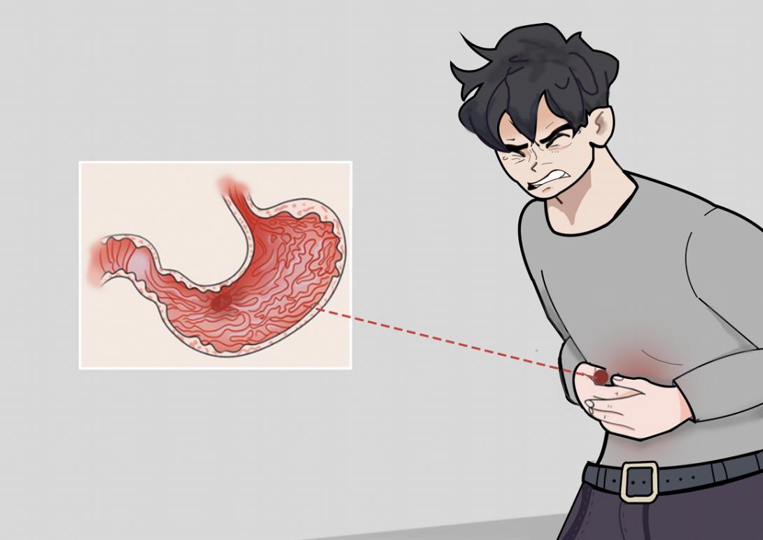 胃溃疡怎么治疗？不健康的生活要摒弃