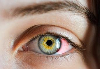 眼睛结膜炎的症状有哪些？如何正确应对?