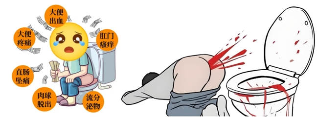 非手术治疗痔疮的探讨