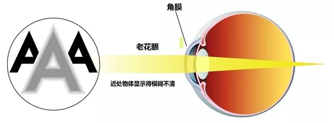 郑州白内障治疗价格—尖峰眼科