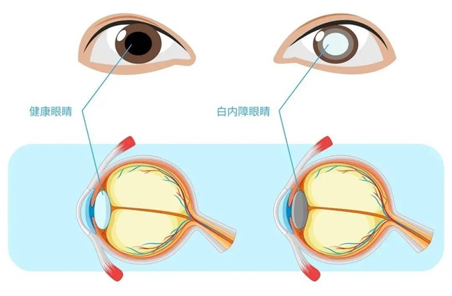 郑州白内障治疗价格—尖峰眼科
